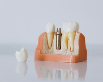 Акция на установку имплантов